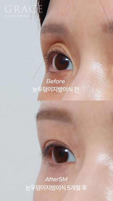 For Those Saddened by Sunken Eyelids (Upper-Eyelid Fat Grafting) image 3