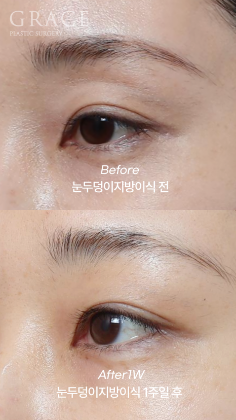 How to Fill Sunken Eyelid Hollows with Fat Grafting (Concerns About Filler Side Effects) image 1