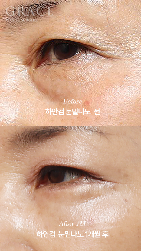 Side Effects of Under-Eye Fat Repositioning? Common Traits of People Who Say It Went Wrong image 6