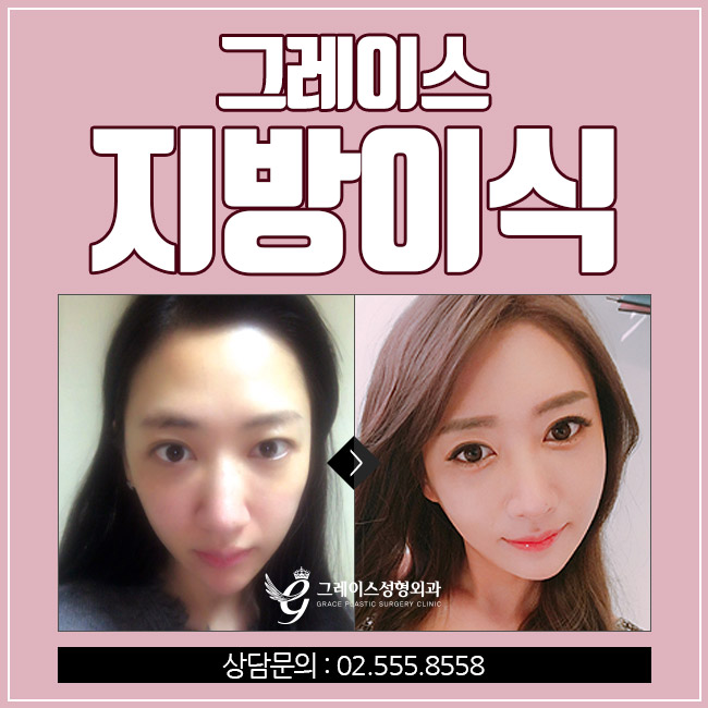 얼굴지방이식을 알아본다면? 신사역 그레이스성형외과 관련 이미지 2