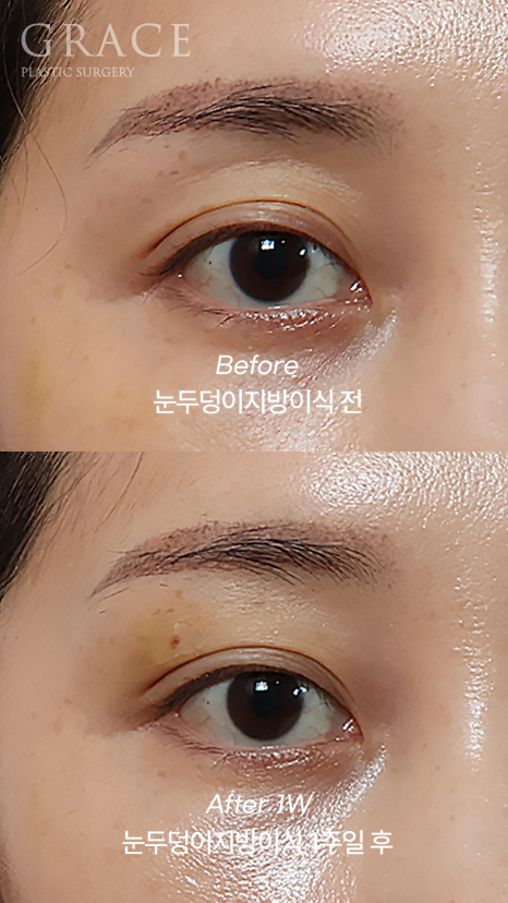눈 감았을 때 울퉁불퉁? 실제 눈두덩이지방이식 전후 관련 이미지 4