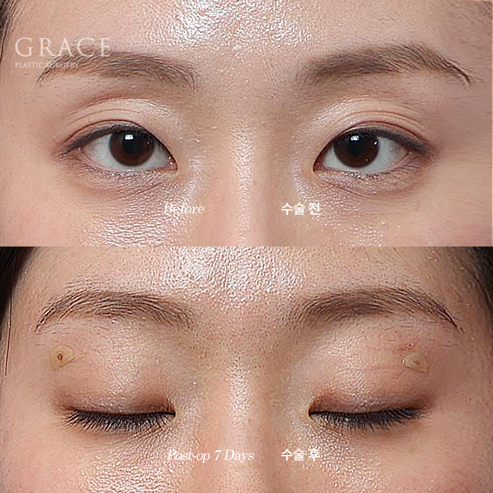 Will a Sunken Upper Eyelid Become Bumpy When You Close Your Eyes After Fat Grafting? image 10