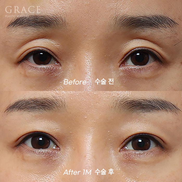 Male Brow Filler? Improvement with Eye-Hole Fat Grafting (Without Worrying About Side Effects, Scars, or Swelling) image 12