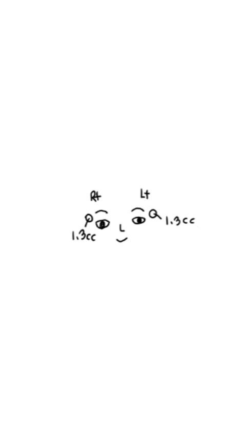 How Long Can Sunken Upper Eyelids Last Without Side Effects After Fat Grafting? image 2