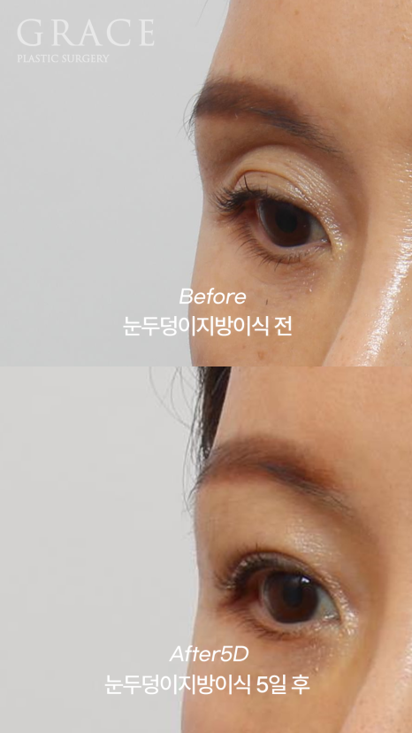 How Long Can Sunken Upper Eyelids Last Without Side Effects After Fat Grafting? image 5