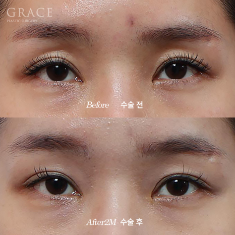 Complications from Sunken Eyelid Fat Grafting? The Injection Location Determines the Result image 2