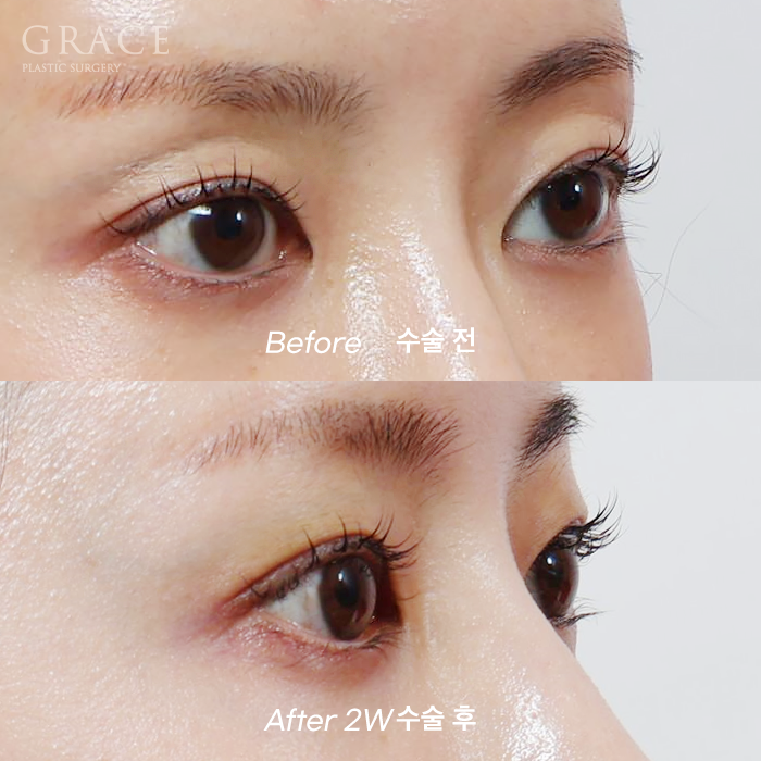 Upper Eyelid Fat Grafting Side Effects? The Difference in Survival Rates Between Frozen Fat and Fresh Fat image 7