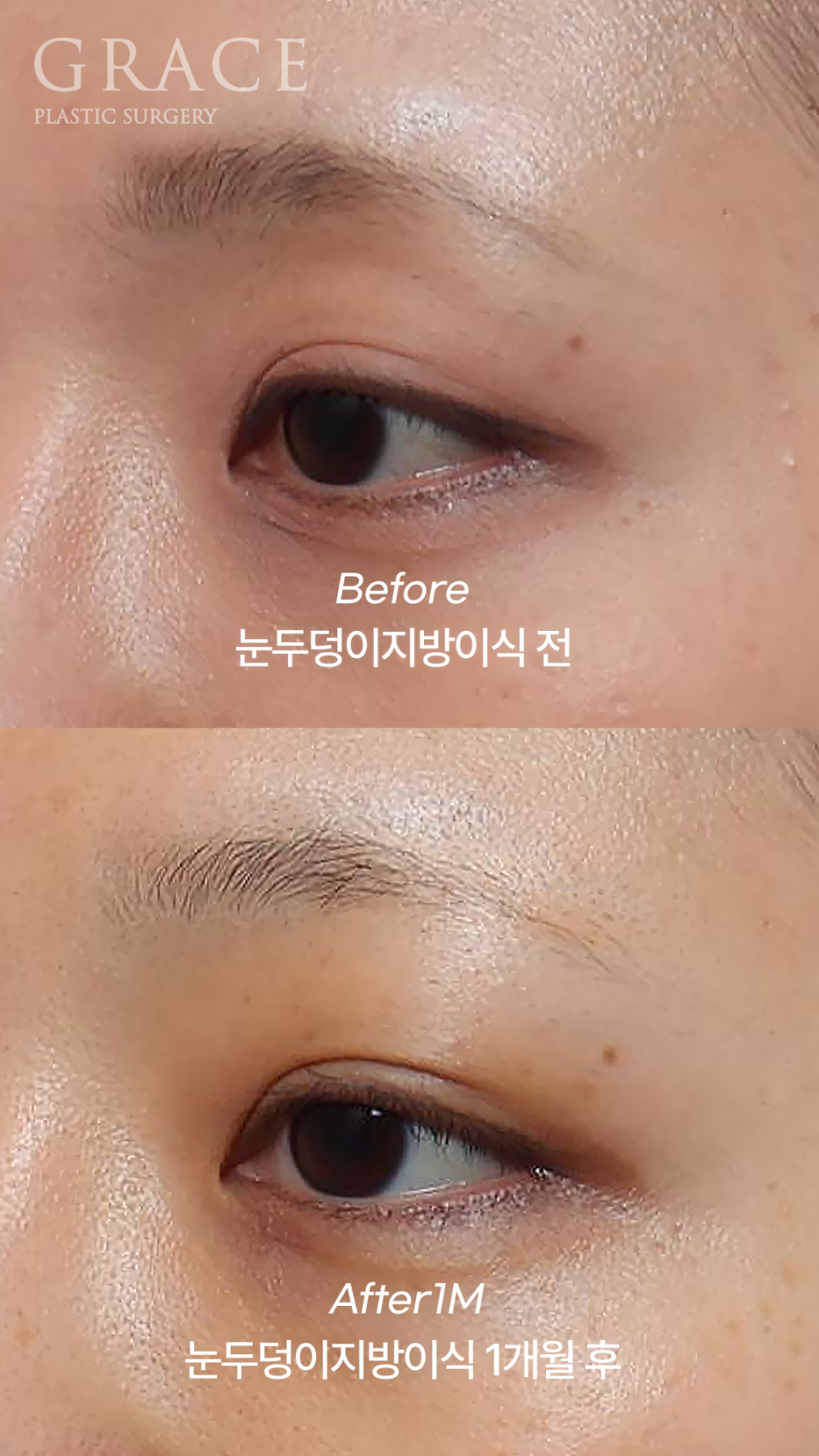 Why Eyelid Hollow Fat Grafting and Orbital Fat Injection Are Important: From Duration of Results to How to Prevent Bumpy Side Effects image 6