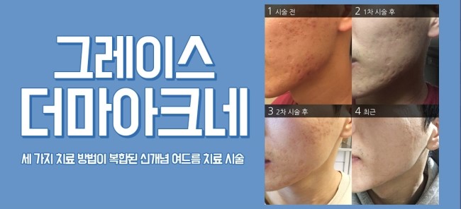 더마아크네 여드름의 원인 파괴와 재발을 예방하다 관련 이미지 3