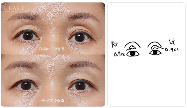 The Real Cause of Side Effects from Upper Eyelid Fat Grafting: the Injection Layer (Orbicularis Oculi Muscle & Orbital Fat) image 3