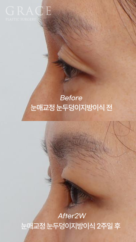 2-Week Swelling Progress After Upper Eyelid Fat Grafting + Incisional Ptosis Correction in Your 40s image 4