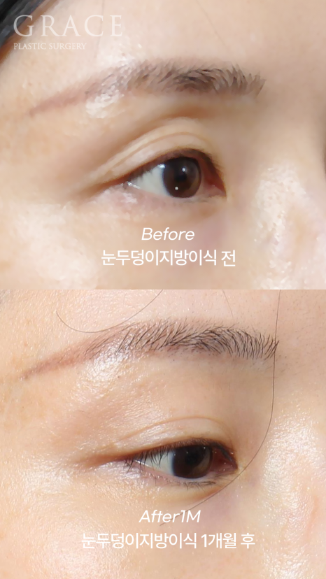 Hollow Eye Holes + Under-Eye Puffiness → (Upper Eyelid Fat Grafting + Fat Repositioning) image 2