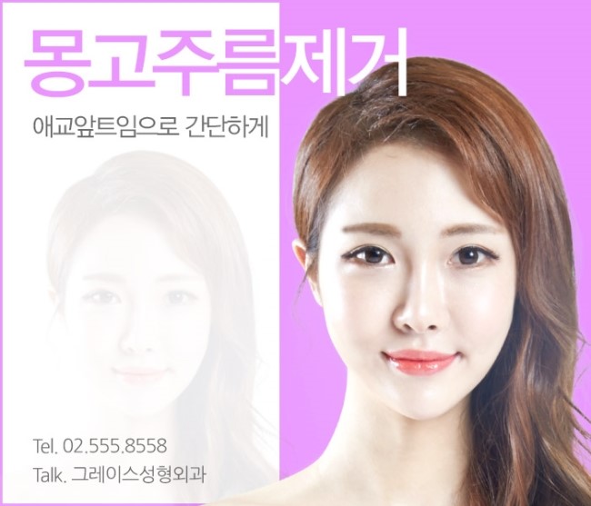 앞트임후기, 그레이스성형외과에서 알아보자! 관련 이미지 6