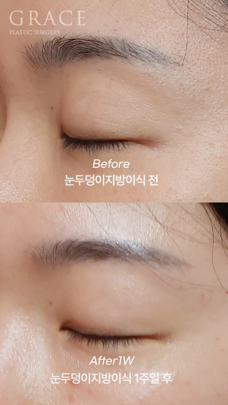 No to Frozen Fat That’s Completely Frozen! Eyelid Fat Grafting with Only Fresh Autologous Fat image 7
