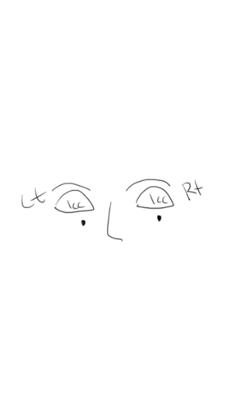눈꺼풀 지방이식 잘하는 병원 그레이스성형외과 관련 이미지 10
