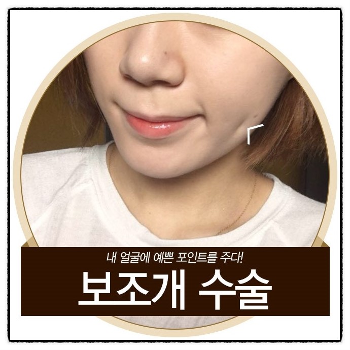 밋밋한 얼굴에 뽀~인트! 그레이스성형외과 보조개 수술 관련 이미지 5