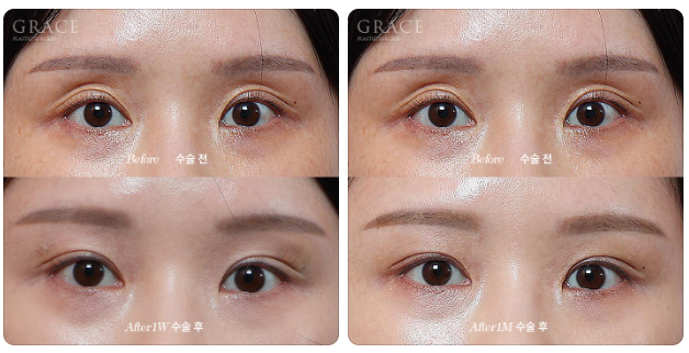 After eyelid fat grafting, do scars remain when you close your eyes? One week later... is this a failure? image 5