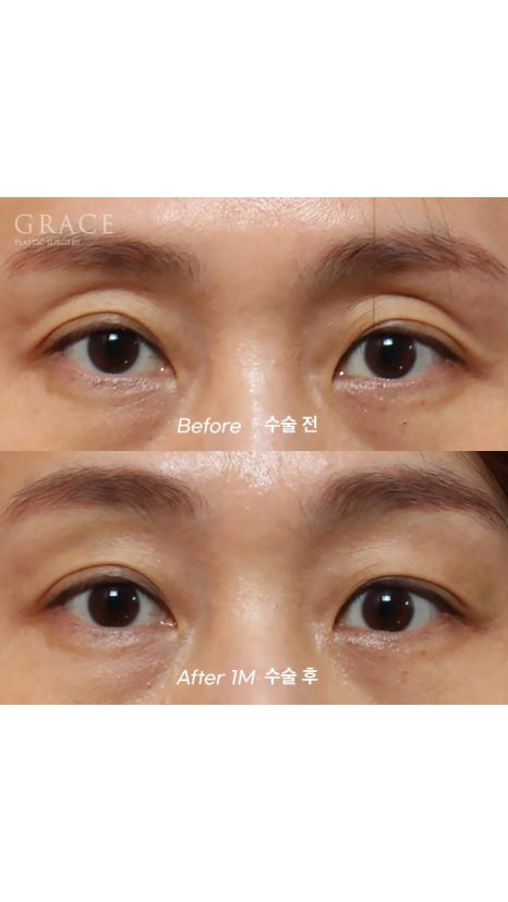 Eyebrow Hollow Fat Grafting Before and After Comparison – Gently Filling Sunken Eyes image 1