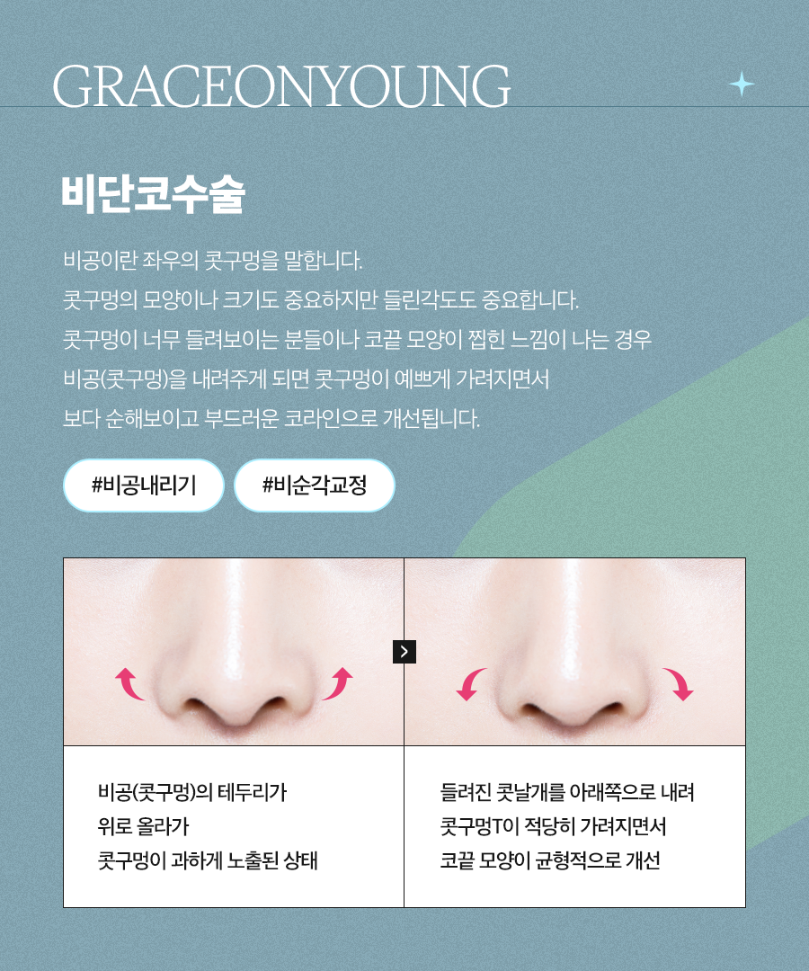 비단코 성형, 이규호 원장님 코끝 성형 관련 이미지 3