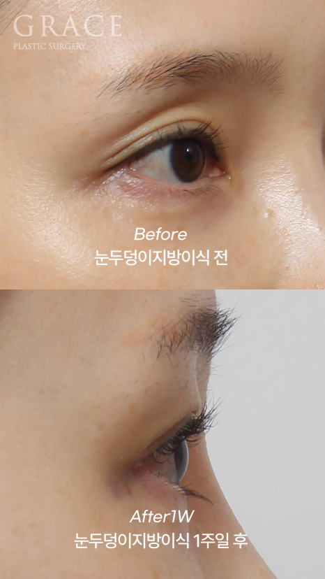 Will Eye Hollow Fat Grafting Really Deflate After 1 Month? 1-Week vs 2-Month Before-and-After Comparison image 7