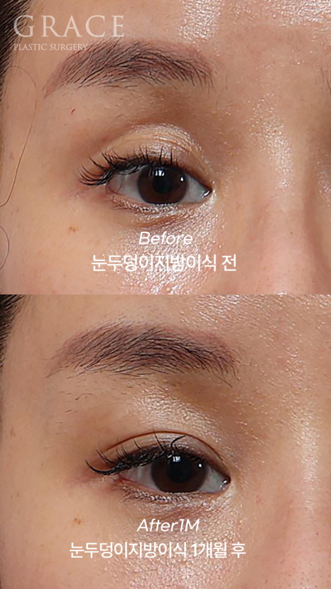 Why Injecting Fat Into the “Orbital Fat” Is Important in Sunken Eye Fat Grafting (dr.essay) image 1