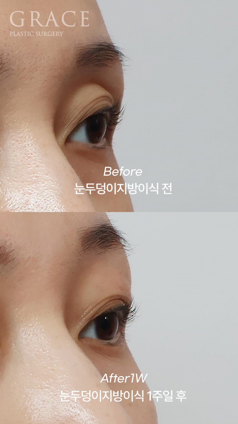 Sunken Eyelid Fat Grafting: Swelling After 1 Week Before & After image 8