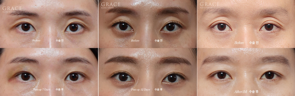 눈두덩이 지방이식을 잘하는 병원이 눈매교정도 잘하는 이유 관련 이미지 4