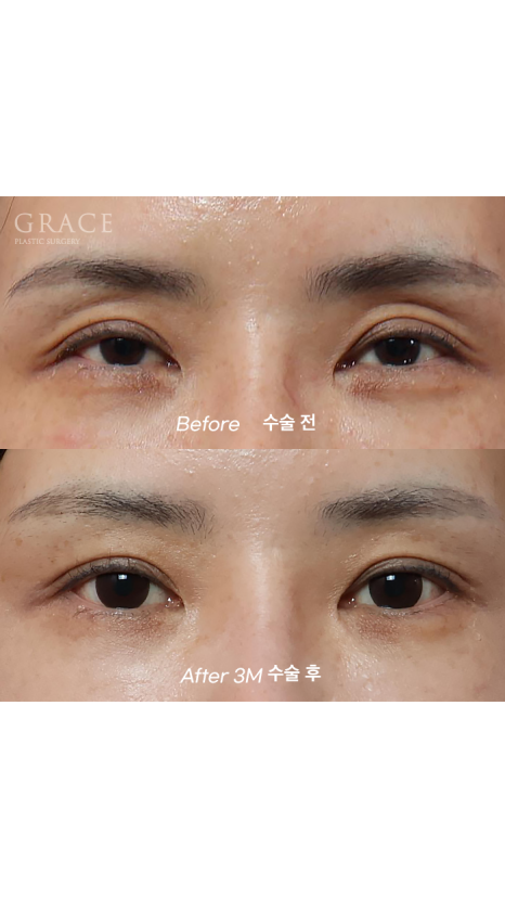 Grace Plastic Surgery 40s Case: Improved Eye-Opening Strength After Upper Eyelid Fat Grafting image 2