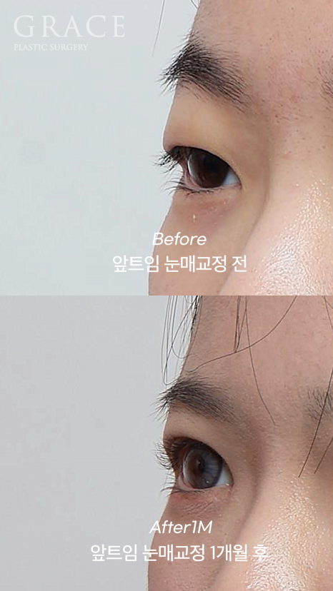 개강 후 난리 났다! 20살 눈매교정 앞트임 전후 관련 이미지 5