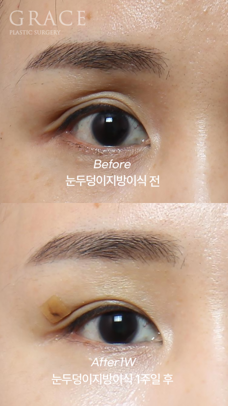 Why Injecting Fat Into the “Orbital Fat” Is Important in Sunken Eye Fat Grafting (dr.essay) image 8