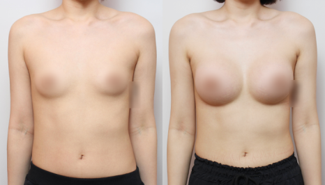 Motiva Full 335cc · 350cc Axillary-Incision Dual-Plane Breast Augmentation: The Difference Made by Vertical Repositioning Before and After image 3