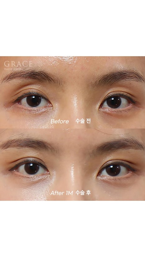 Eyebrow Hollow Fat Grafting Before and After Comparison – Gently Filling Sunken Eyes image 4