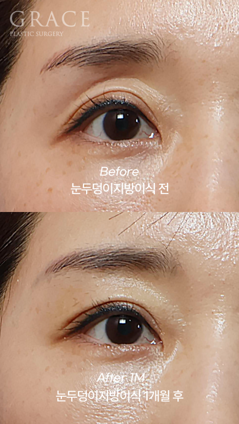Eyelid Fat Grafting Side Effects? How to Settle In Beautifully Without Lumps image 4