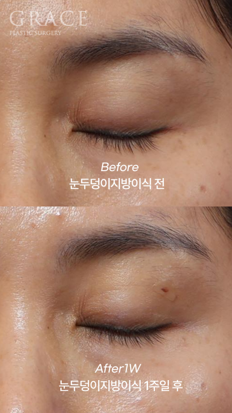 Sagging Eye Hollows and Sunken Eyelid Fat Grafting: Reasonable Cost (Price) Information and image 5