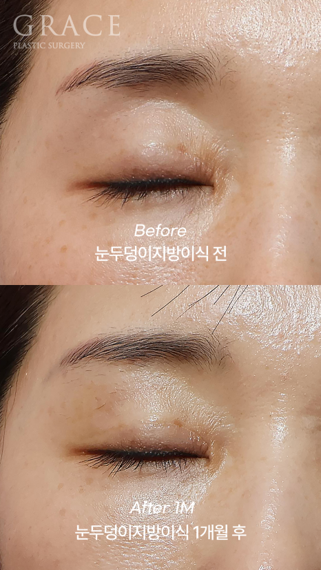 Eyelid Fat Grafting Side Effects? How to Settle In Beautifully Without Lumps image 3