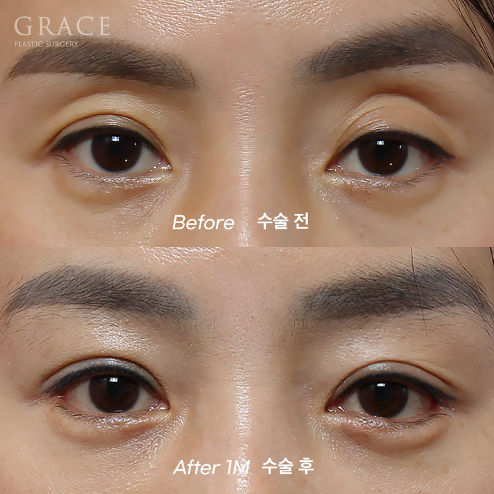 Eye Fat Grafting Instead of Eyelid Filler: Eye Shape Correction (1-Week Swelling Level) image 1