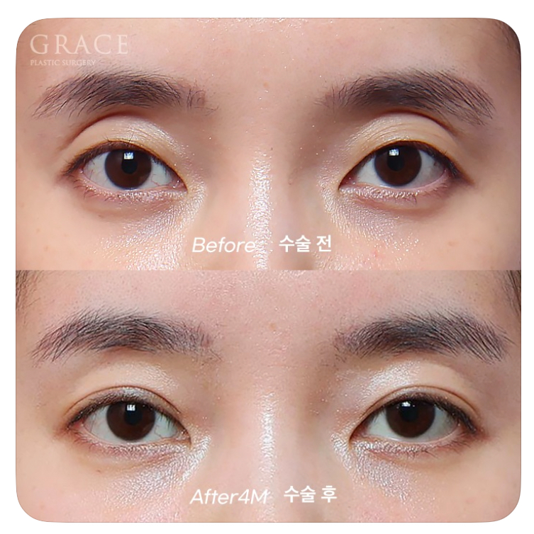 Causes of Sunken Eyelids and How Eyelid Fat Grafting Can Change Your Impression image 5