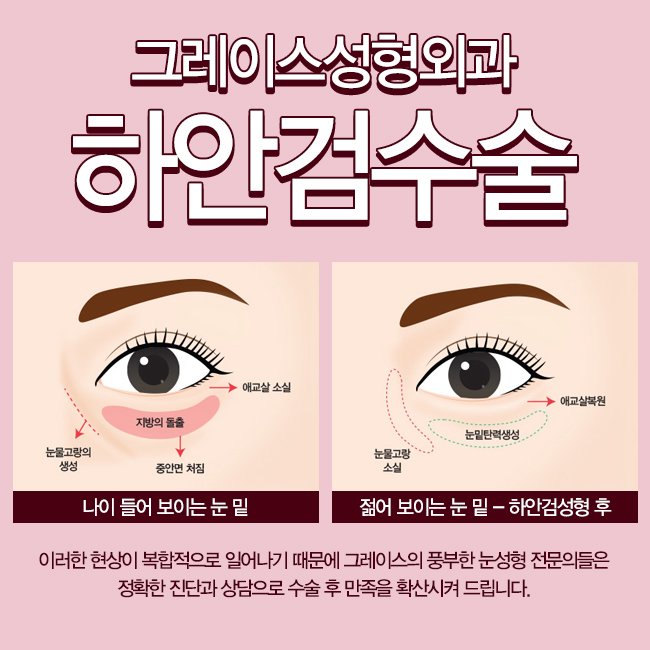돌출되어 있는 눈 밑 지방, 그레이스성형외과 하안검수술이 정답! 관련 이미지 2