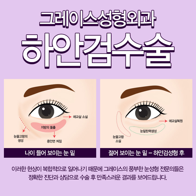 하안검수술후기, 그레이스성형외과에서 확인해보세요. 관련 이미지 3