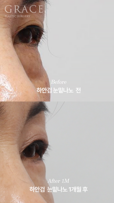 Side Effects of Under-Eye Fat Repositioning? Common Traits of People Who Say It Went Wrong image 4