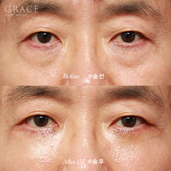 60대 눈밑성형 하안검과 눈밑지방재배치 차이 관련 이미지 6