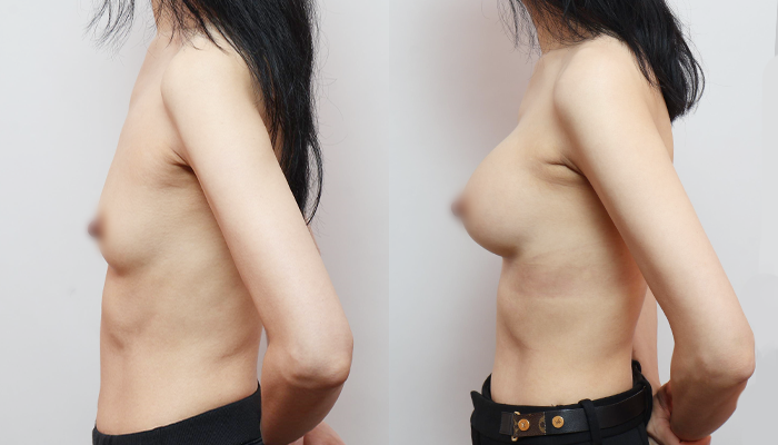 모티바 Demi 300cc│280cc 가슴성형 그레이스성형외과 관련 이미지 1