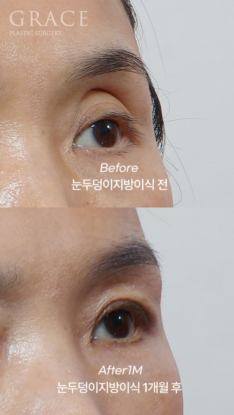 눈꺼풀 지방이식 절개 없이 아이홀 부위를 채우기 관련 이미지 8