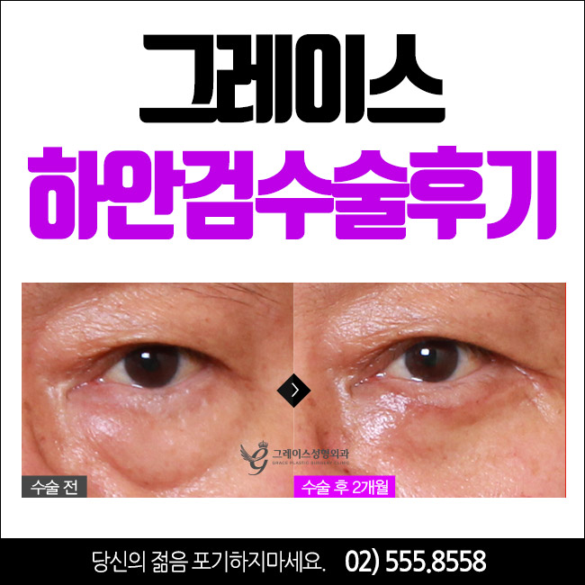 하안검수술후기로 부모님의 젊음을 찾아드리자! 관련 이미지 1