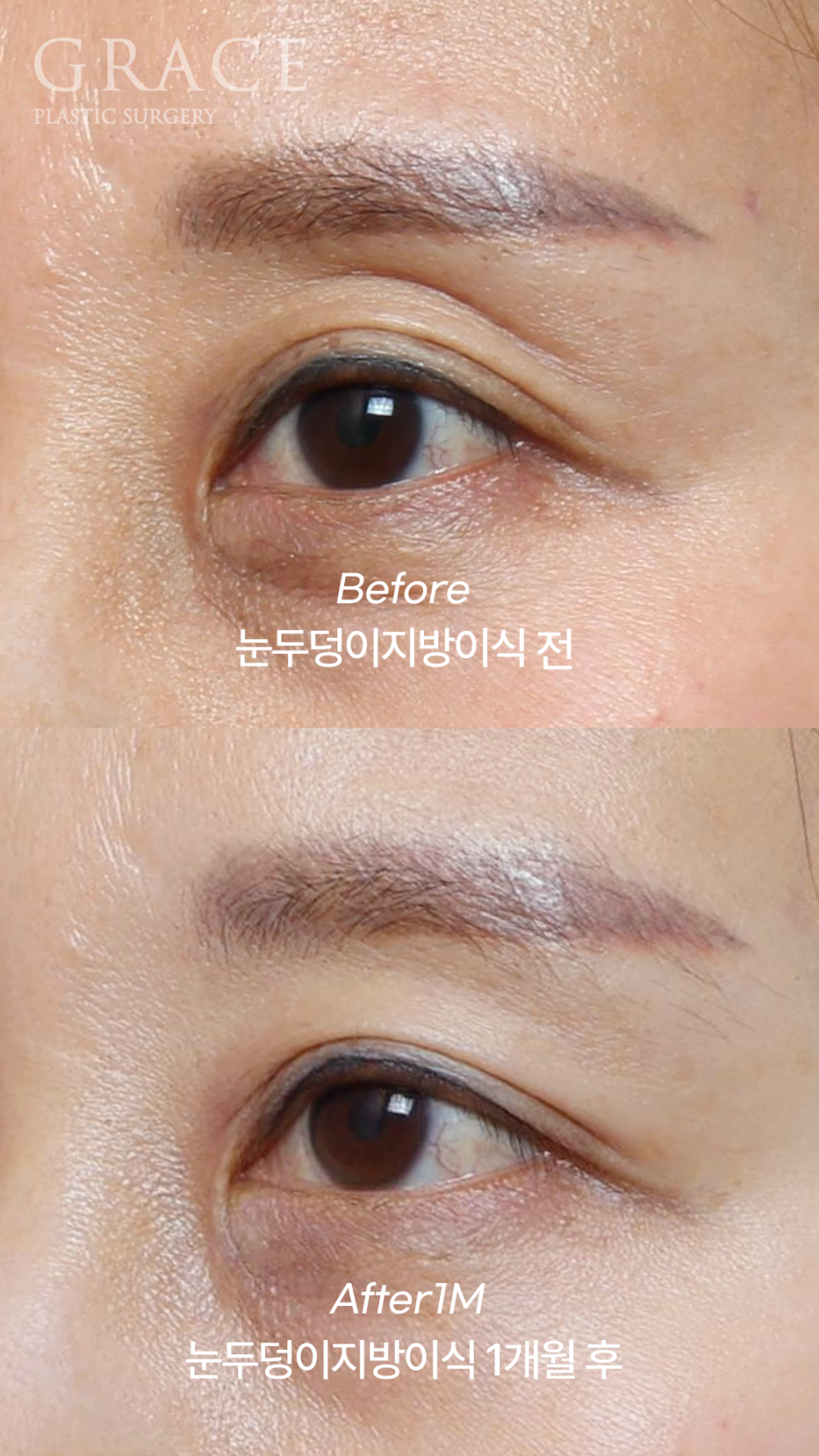 How to Fix a Sunken Eye Hollow: Upper Eyelid Fat Grafting + Ptosis Correction image 3