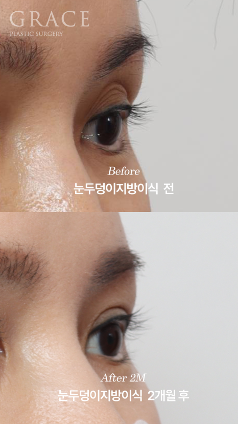 Will Swelling After Eyelid Fat Grafting Last a Long Time... Is It Really True? image 7
