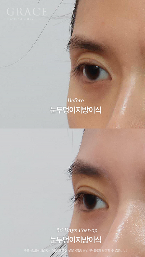 가을 되니 유독 퀭해 보이는 눈가 걱정? 눈두덩이 지방이식 56일차 관련 이미지 3