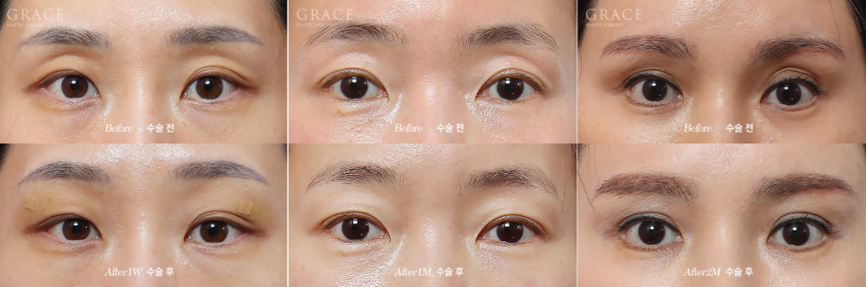 Is a Second Eyelid Fat Grafting Necessary? Are Frozen Fat Grafts a Side Effect? image 7