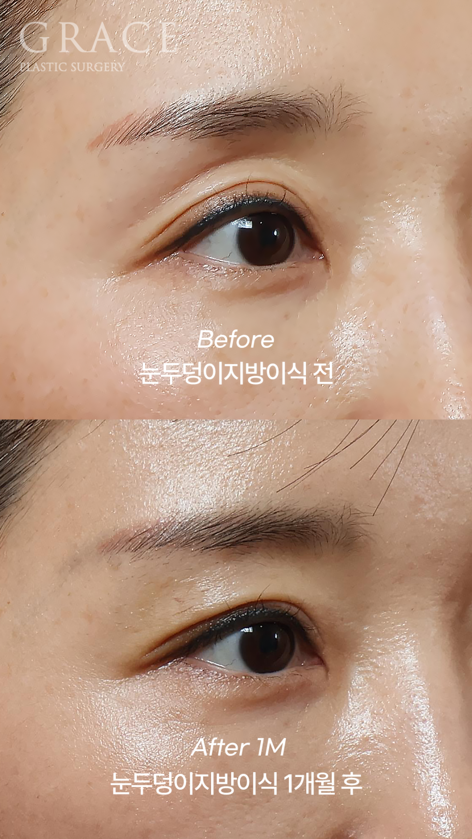 눈꺼풀 지방이식 부작용 왜 생기는지 아시나요? 관련 이미지 2