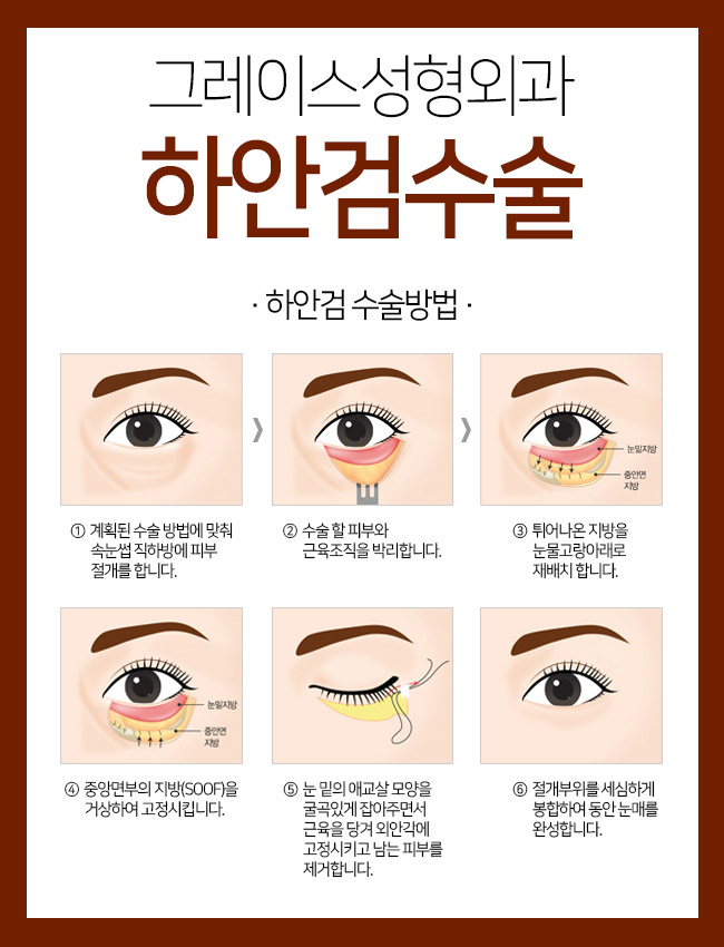 돌출되어 있는 눈 밑 지방, 그레이스성형외과 하안검수술이 정답! 관련 이미지 4